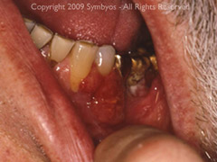 Squamous cell carcinoma arising on the patient's lower left gingiva.