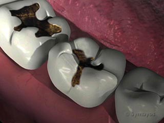 Tooth Decay (a video for kids)