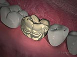 Materials Options for Crowns and Onlays
