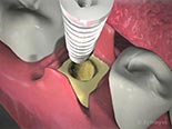 Dental Implant Surgery Traditional Technique