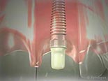 Dental Implant (Immediate Tooth Replacement)