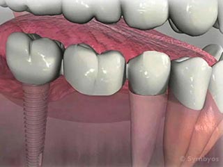 Dental Implant-Supported Bridges