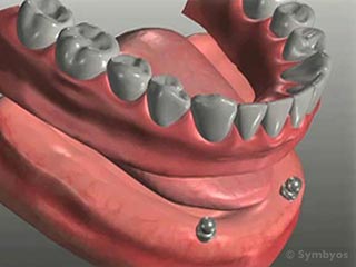 Dental Implant-Stabilized Removable Dentures