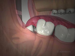 Common Reasons for Tooth Removal
