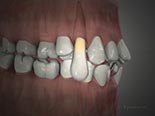 Simple Tooth Removal
