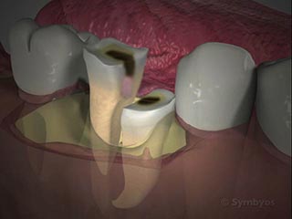 Surgical Tooth Removal