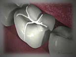Dental Sealants (and Fissurotomy)