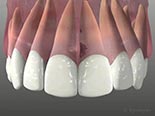 Tooth Root Resorption