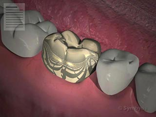 Guidelines for Crowns, Inlays and Onlays