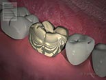 Guidelines for Crowns, Inlays and Onlays
