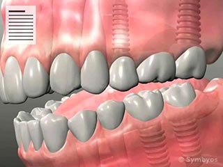 Guidelines Following Dental Implant Surgery