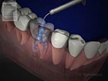 Guidelines Following Endodontic Treatment