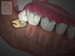 Guidelines Following Tooth Removal