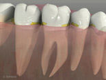 Tooth Decay Between Teeth