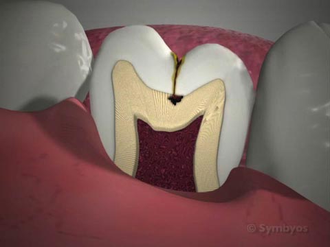 Pit and Fissure Cavities