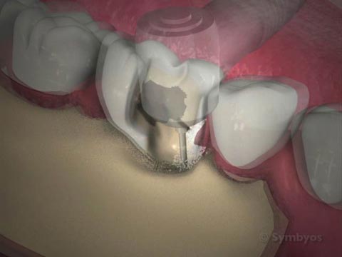 Hard Tissue Crown Lengthening