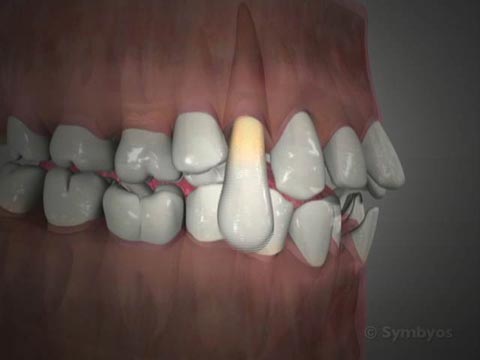 Simple Tooth Removal
