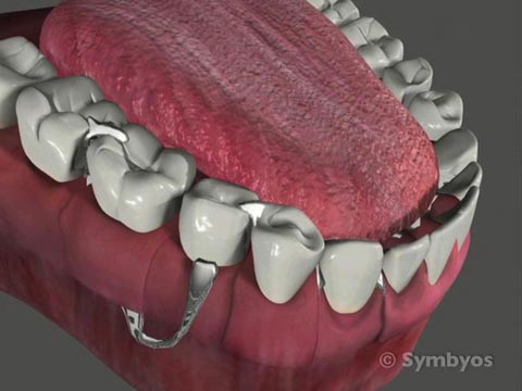 Removable Partial Dentures