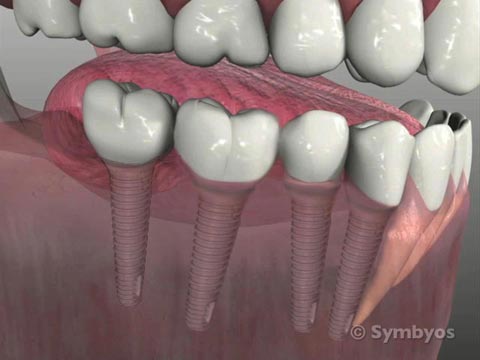 Common Dental Implant Applications