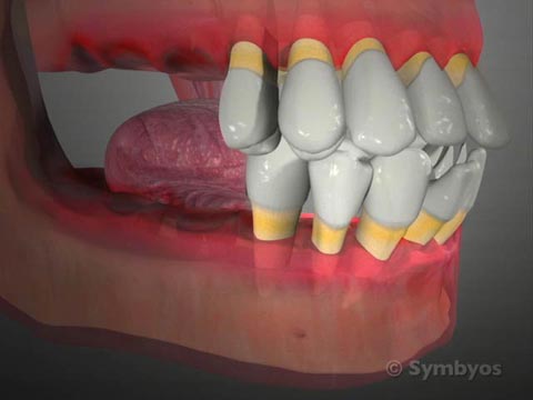 Periodontal Stabilization Splints