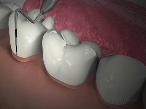 Thorough Periodontal Examinations