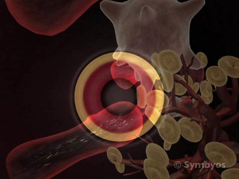 Periodontal Disease and C-Reactive Protein